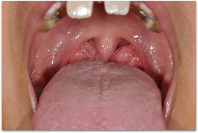 The Tongue’s Role in Pediatric Sleep Disorders and Skeletal Growth and Development image 1