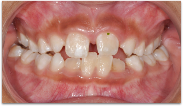 The Tongue’s Role in Pediatric Sleep Disorders and Skeletal Growth and Development image 3