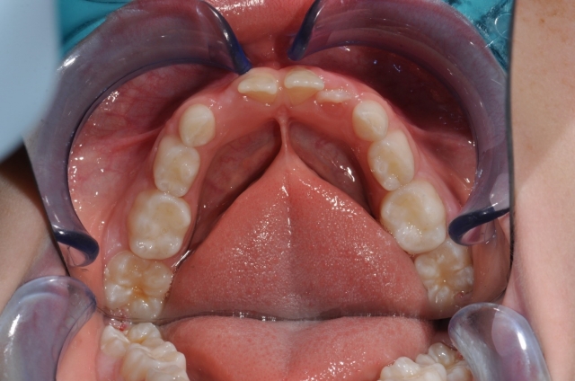 The Tongue’s Role in Pediatric Sleep Disorders and Skeletal Growth and Development image