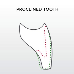 Flat or Wrap When Preparing Anterior Teeth? Robert Winter Flat or Wrap When Preparing Anterior Teeth proclined tooth