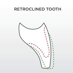 Flat or Wrap When Preparing Anterior Teeth? Robert Winter Flat or Wrap When Preparing Anterior Teeth retroclined tooth