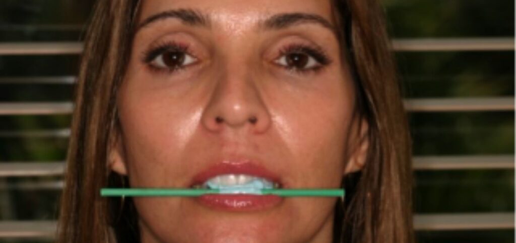Why a Facebow Is Essential for Restorative Success Stick bite technique using a green rod aligned across the incisal edges, an alternative some clinicians use instead of a facebow