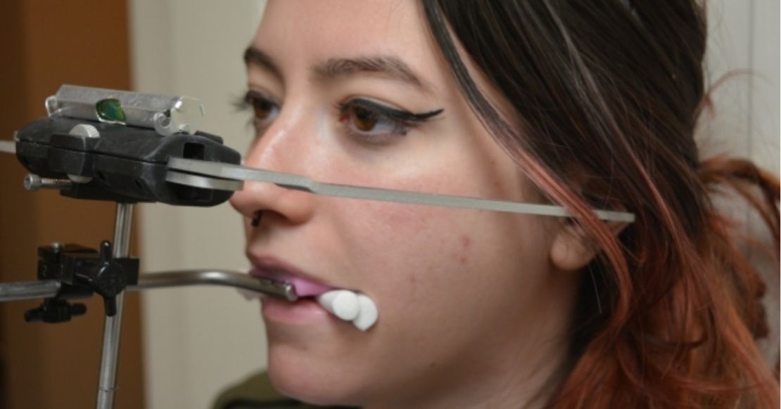 Why a Facebow Is Essential for Restorative Success Arbitrary facebow (earbow) positioned on a patient, showing the bite fork and anterior reference pointer used to orient the maxillary cast