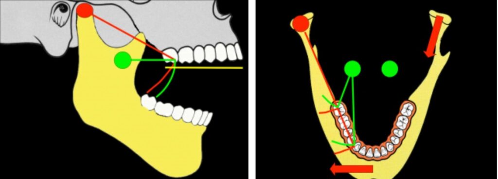 Why a Facebow Is Essential for Restorative Success Diagram comparing the condylar arc of closure in lateral and frontal views, showing how facebow-guided positioning differs from a hinge-axis assumption