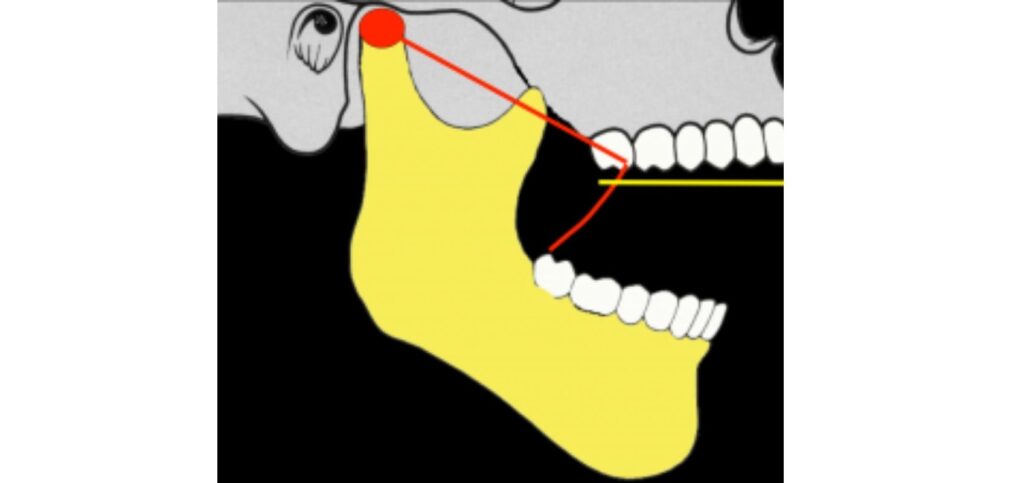 Why a Facebow Is Essential for Restorative Success iagram of the mandible showing the condylar rotational axis and the arc of closure, a facebow helps record