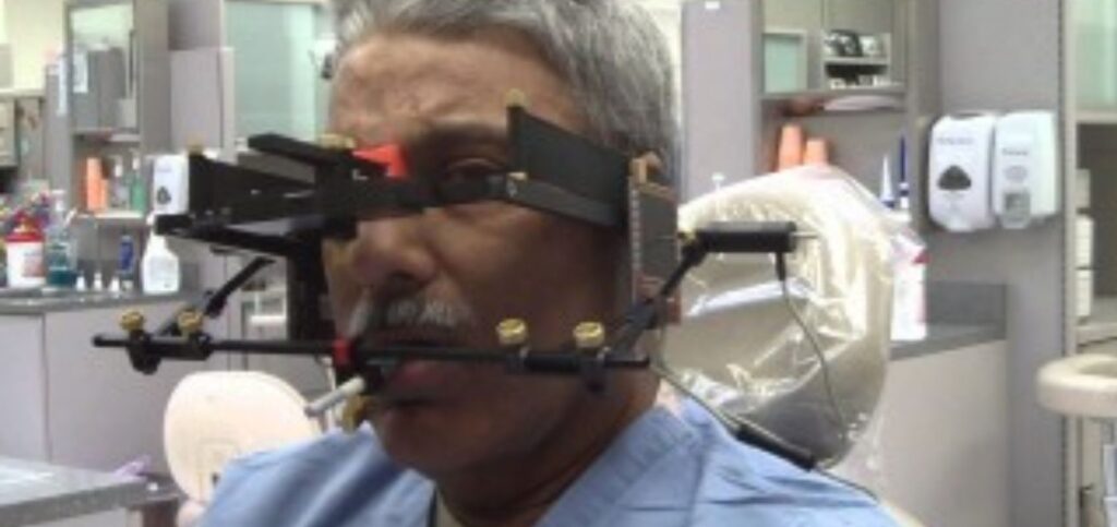 Why a Facebow Is Essential for Restorative Success Patient in a dental chair fitted with a facebow frame, showing the earpiece attachment and bite fork used to record jaw position
