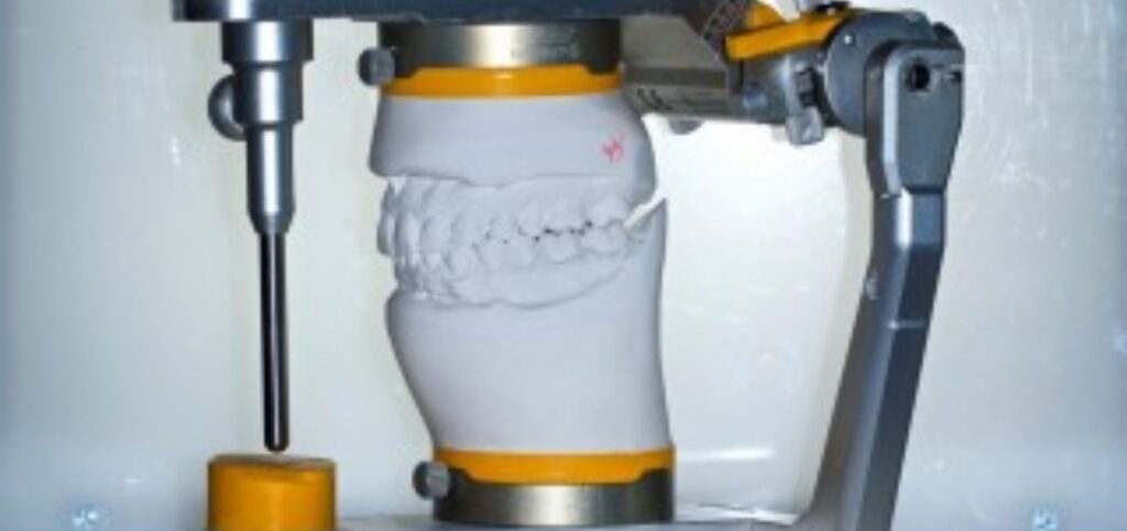Why a Facebow Is Essential for Restorative Success Dental casts mounted on a semi-adjustable articulator using facebow-recorded positioning, showing the upper and lower models in occlusion