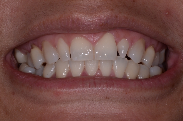 How To Do No-Prep Restorations image 1