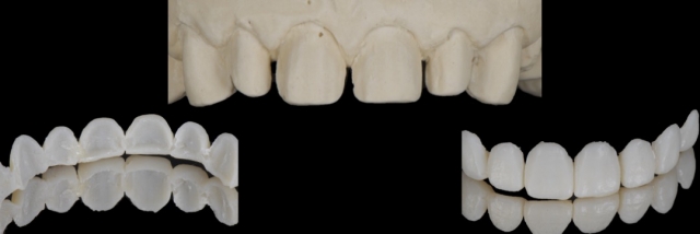 6 Steps to Creating a Removable Veneer Temporary image 10