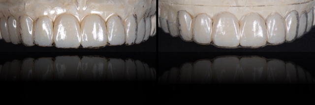 6 Steps to Creating a Removable Veneer Temporary image 11