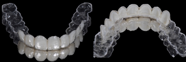 6 Steps to Creating a Removable Veneer Temporary image 12