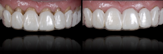 6 Steps to Creating a Removable Veneer Temporary image 13