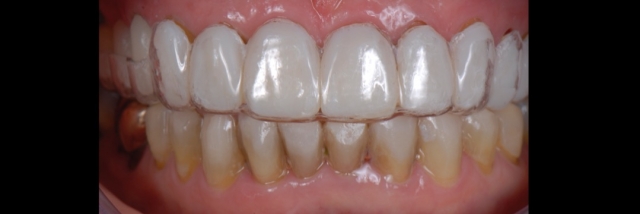 6 Steps to Creating a Removable Veneer Temporary image 14