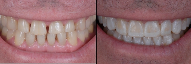 6 Steps to Creating a Removable Veneer Temporary image 15