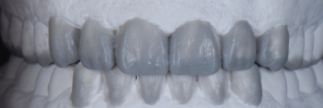 6 Steps to Creating a Removable Veneer Temporary image 16