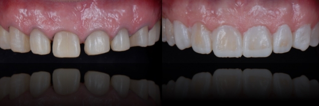 6 Steps to Creating a Removable Veneer Temporary image 17