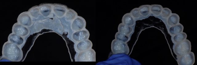 6 Steps to Creating a Removable Veneer Temporary image 18