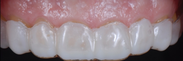 6 Steps to Creating a Removable Veneer Temporary image 19