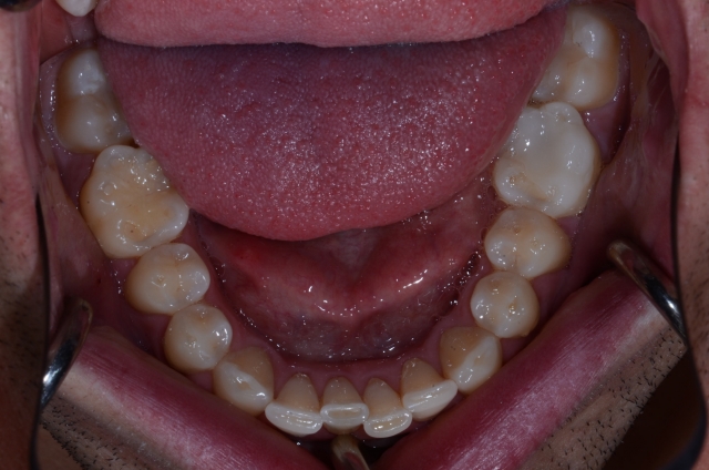 How To Do No-Prep Restorations image 2