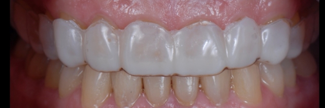 6 Steps to Creating a Removable Veneer Temporary image 20