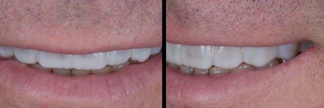 6 Steps to Creating a Removable Veneer Temporary image 21