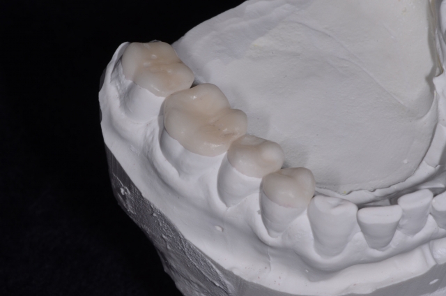 How To Do No-Prep Restorations image 3
