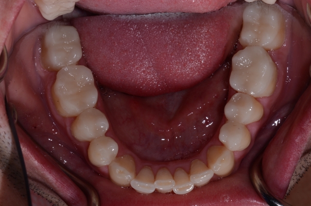 How To Do No-Prep Restorations image 4