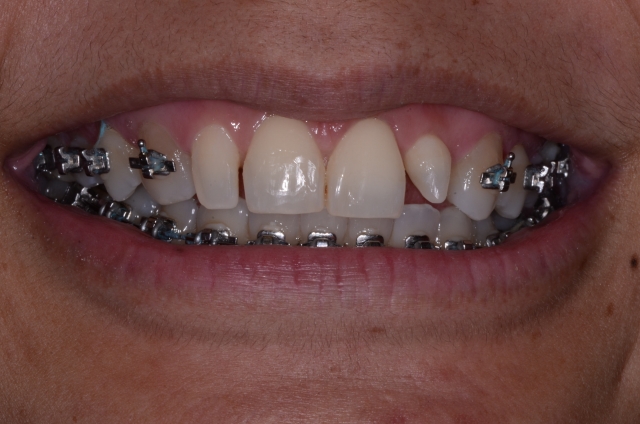 How To Do No-Prep Restorations image 5