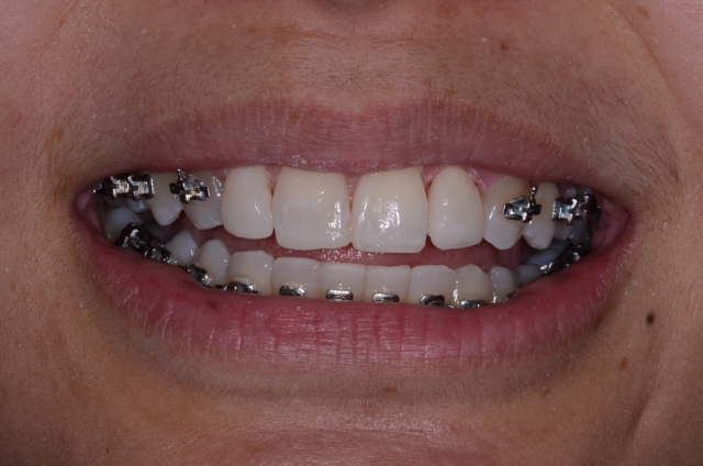 How To Do No-Prep Restorations image 6