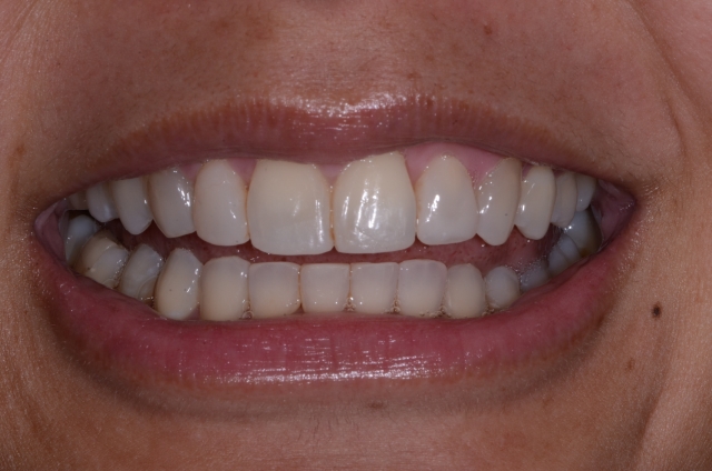 How To Do No-Prep Restorations image 7