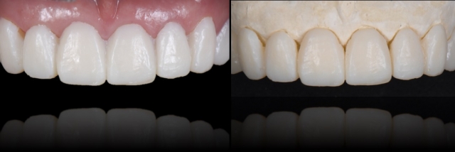 6 Steps to Creating a Removable Veneer Temporary image 9