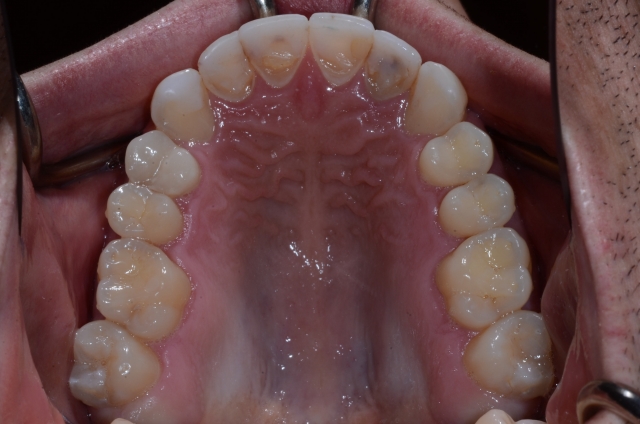 How To Do No-Prep Restorations image