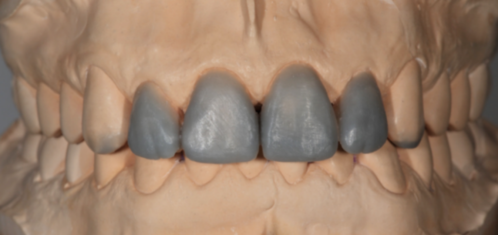 Dental Diagnostic Wax Up: Why It Matters and How It's Made Maxillary anterior teeth waxed on the cast during a dental diagnostic wax up.