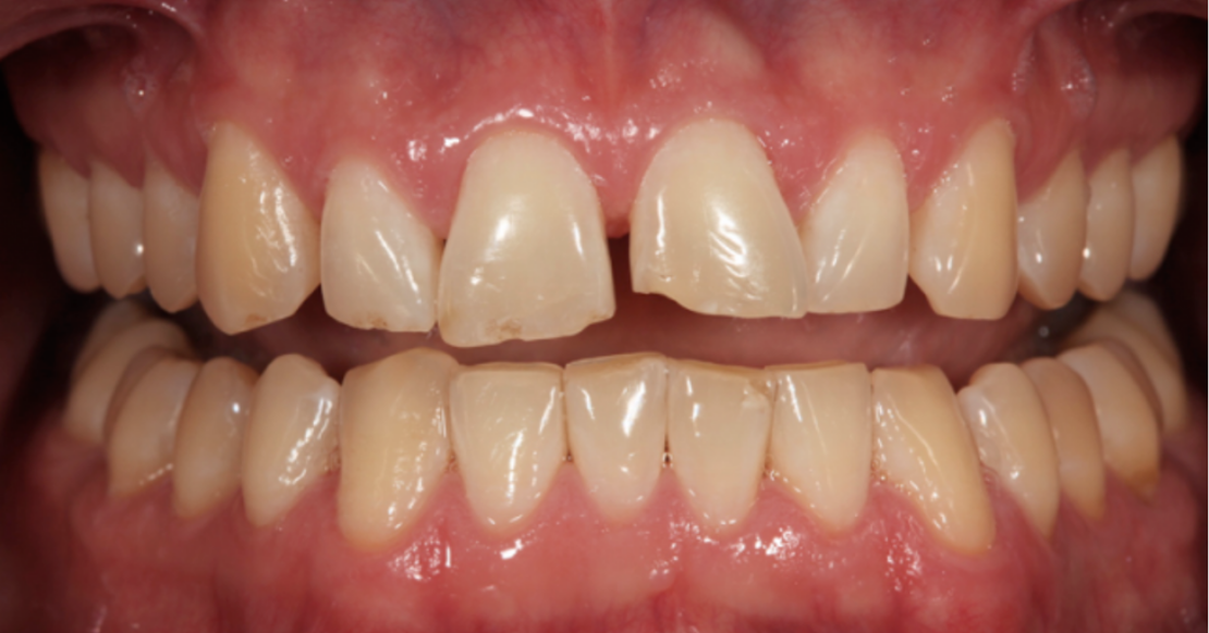 Dental Diagnostic Wax Up: Why It Matters and How It's Made Pretreatment intraoral photo of worn, chipped anterior teeth before a dental diagnostic wax-up.