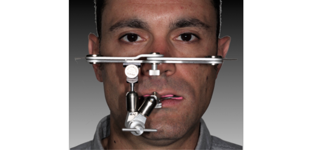 Dental Diagnostic Wax Up: Why It Matters and How It's Made Patient fitted with a facebow transfer device used to mount casts for a dental diagnostic wax-up.