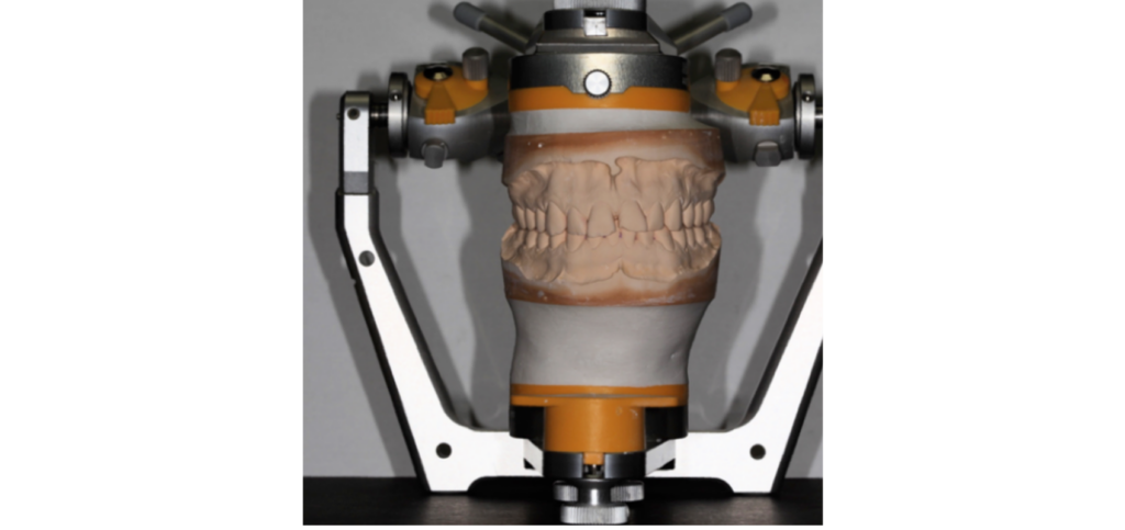 Dental Diagnostic Wax Up: Why It Matters and How It's Made Dental casts mounted on an articulator, the starting point for a dental diagnostic wax-up