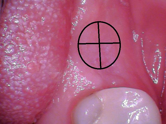 How to Uncover an Implant 101 image 1