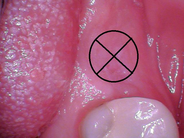 How to Uncover an Implant 101 image 2