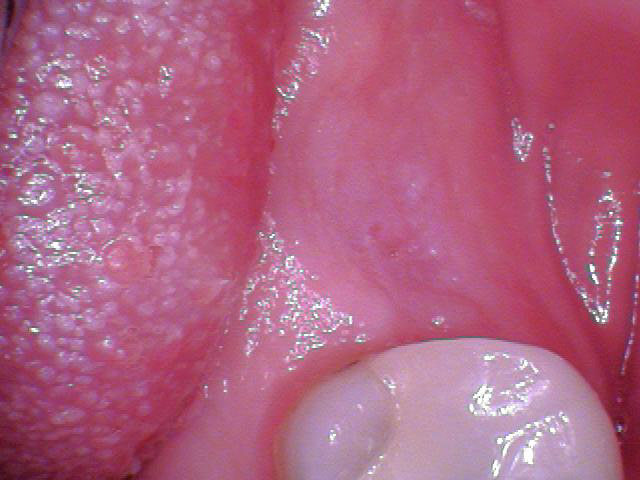 How to Uncover an Implant 101 image 3