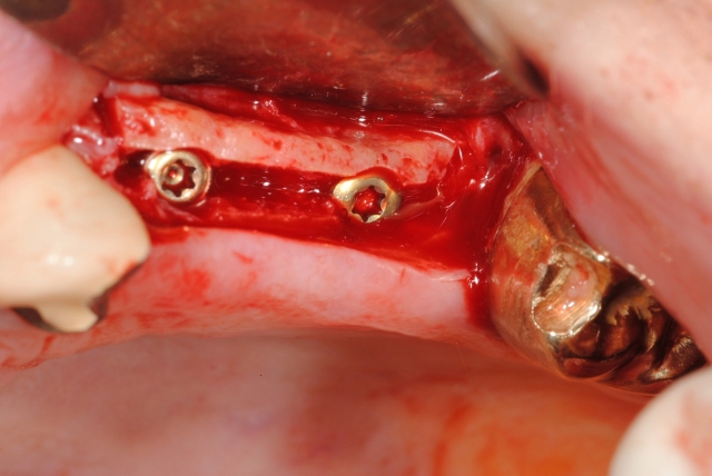 How to Uncover an Implant 101 image 4