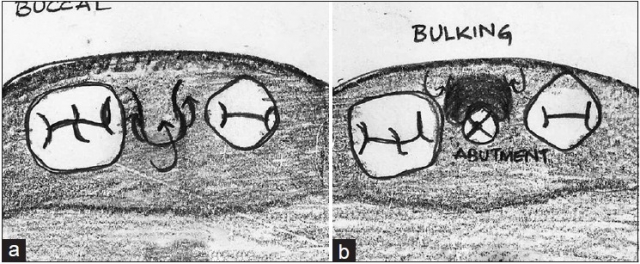 How to Uncover an Implant 101 image 5