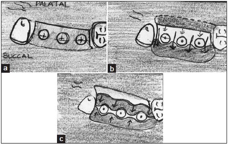 How to Uncover an Implant 101 image 6