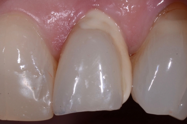 Radiographs and Cement: You Can’t Handle the Truth! image 7