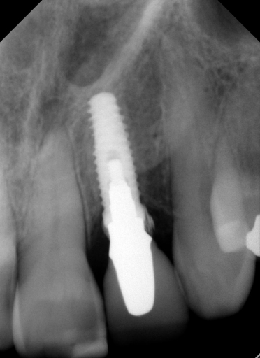 Radiographs and Cement: You Can’t Handle the Truth! image 8