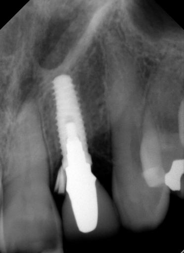 Radiographs and Cement: You Can’t Handle the Truth! image 9