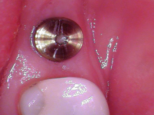 How to Uncover an Implant 101 image