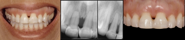 The Guide to When and When Not to Splint Restorations Gregg Kinzer The Guide to When and When Not to Splint Restorations Fig 1