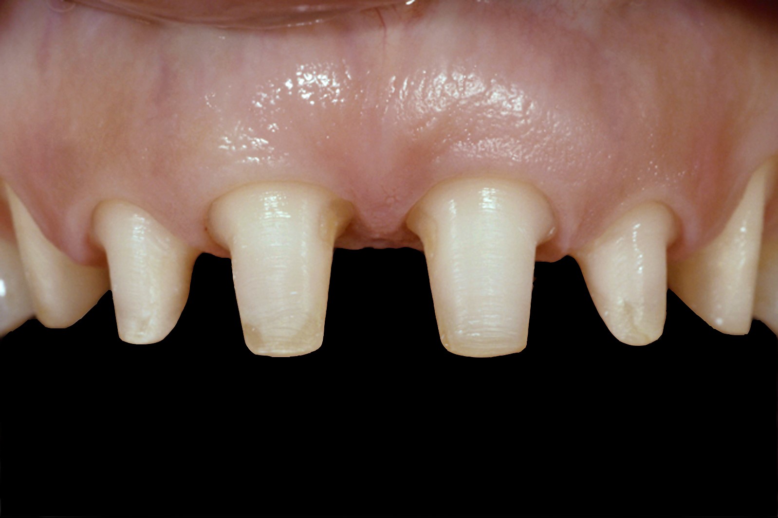 Gregg Kinzer The Guide to When and When Not to Splint Restorations Fig 2