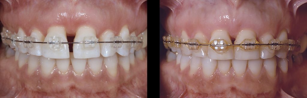 The Guide to When and When Not to Splint Restorations The Guide to When and When Not to Splint Restorations Fig 3
