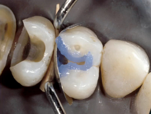 Dentin Adhesives for Direct Posterior Composite image